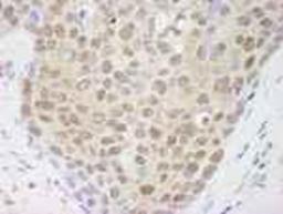 Immunohistochemistry-Paraffin: Cullin 4a Antibody [NB100-2267] - FFPE section of human breast tumor.  Affinity purified rabbit anti-Cul4a used at a dilution of 1:500.