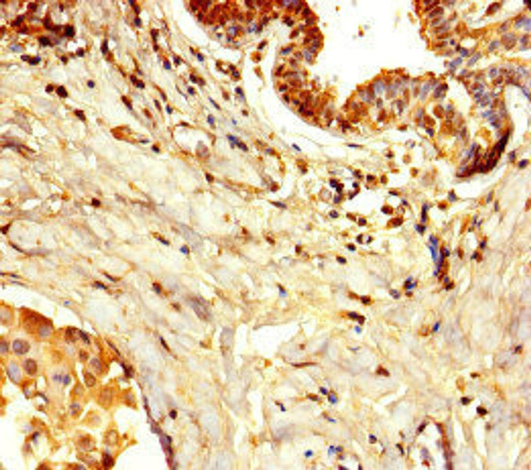 Immunohistochemistry of paraffin-embedded human breast cancer using CSB-PA866281LA01HU at dilution of 1:100