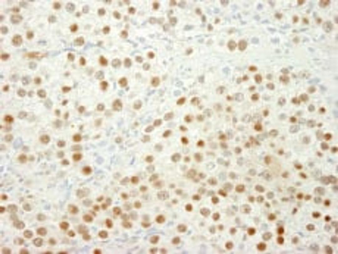 Detection of human MSH6 by immunohistochemistry.