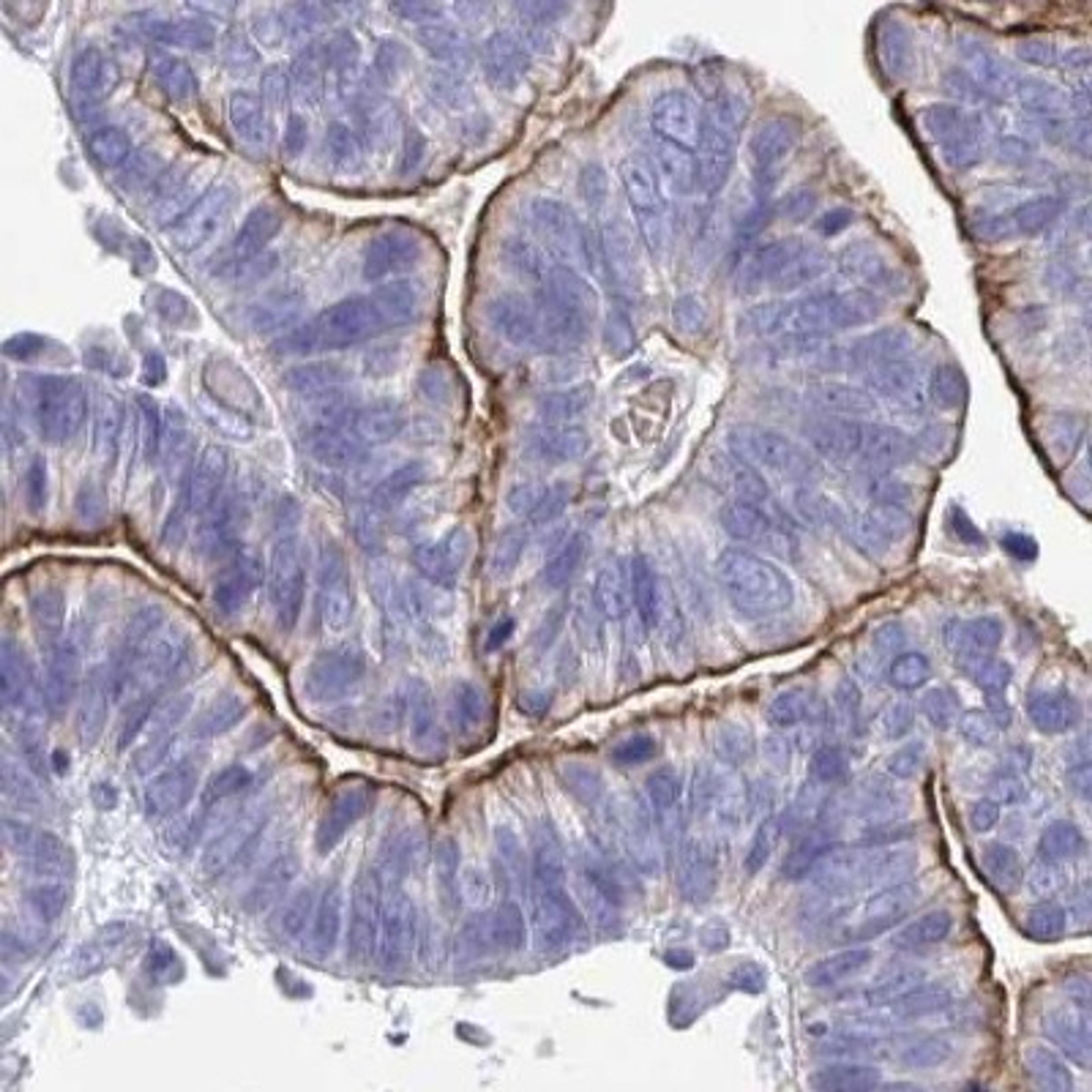 Immunohistochemistry: HHLA1 Antibody [NBP2-32420] - ovarian cancer