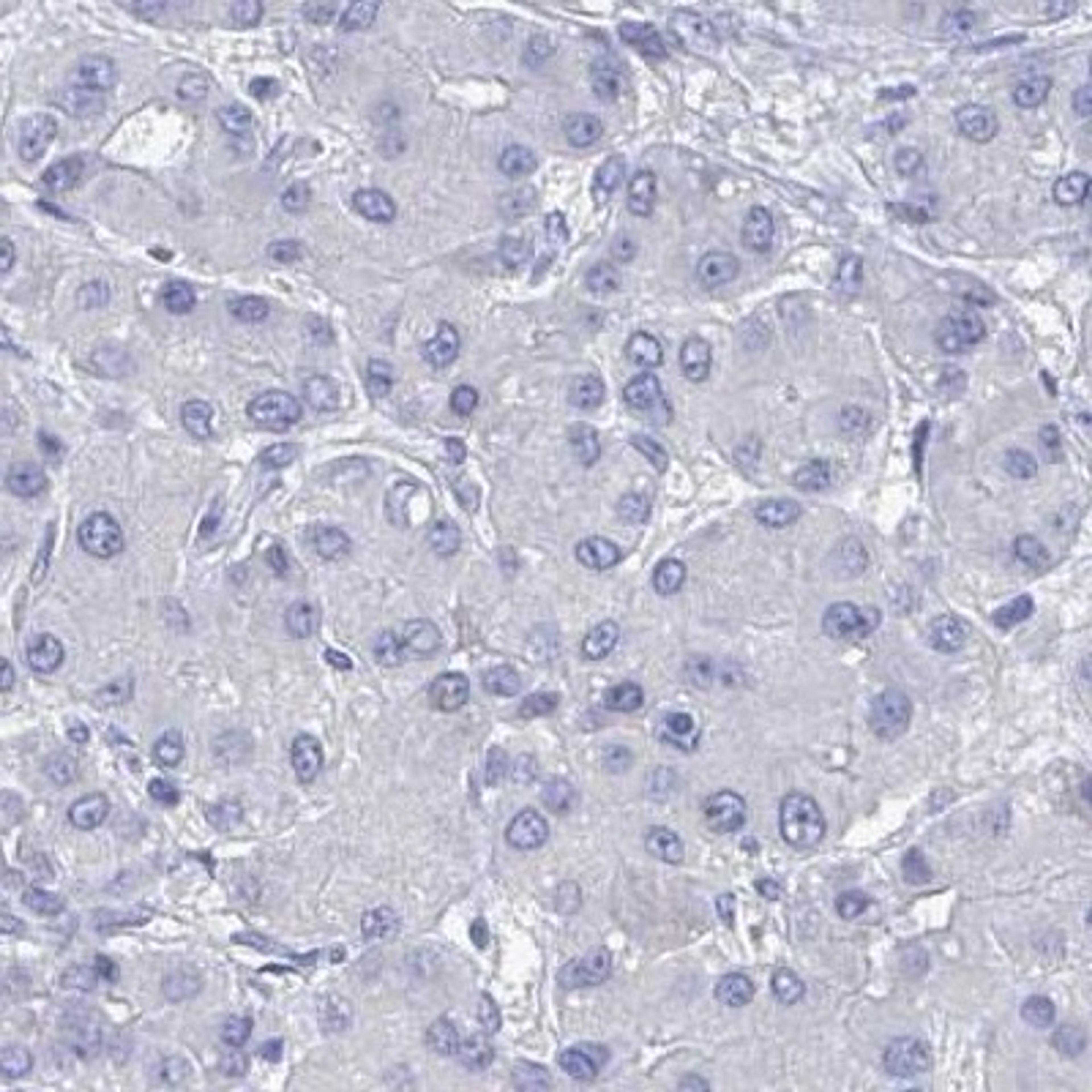 Immunohistochemistry: Interleukin 34 Antibody [NBP2-31620] - liver cancer