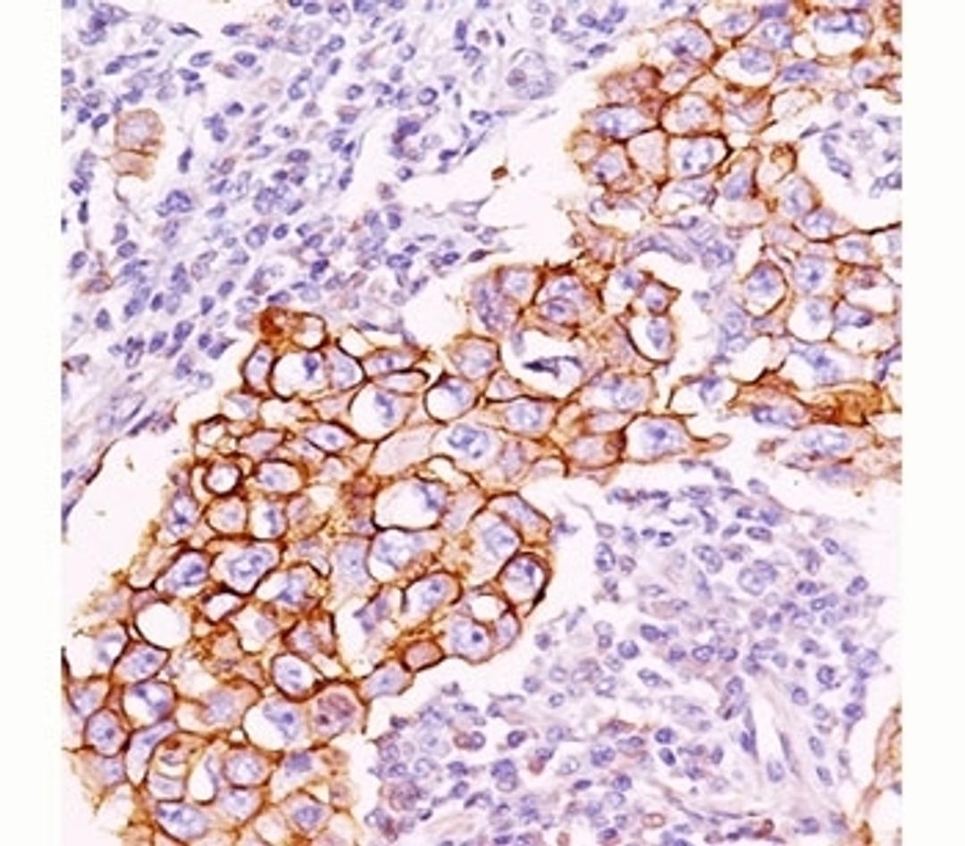 IHC staining of breast carcinoma with phosphotyrosine antibody (PY20). Note cell surface and cytoplasmic staining.