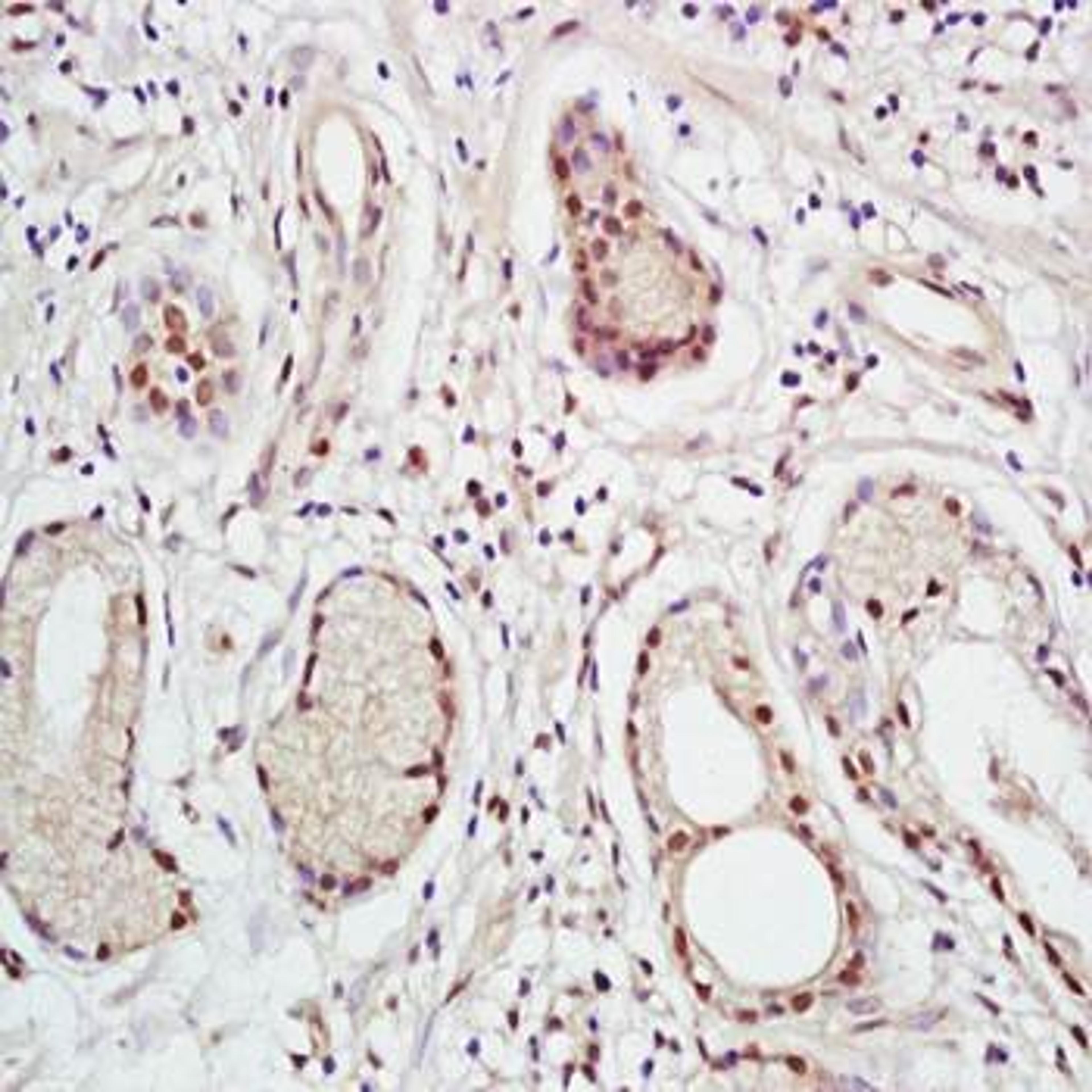 Immunohistochemical analysis of formalin-fixed and paraffin embedded human gastric cancer tissue (Dilution at:1:200) using XPC antibody