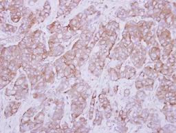 Immunohistochemistry-Paraffin: Periplakin Antibody [NBP2-19775] - Immunohistochemical analysis of paraffin-embedded Breast ca, using antibody at 1:250 dilution.