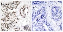 Immunohistochemistry-Paraffin: Chk2 [p Thr68] Antibody [NBP1-60801] - Analysis of paraffin-embedded human lung carcinoma, using Chk2 (Phospho-Thr68) Antibody. The picture on the right is treated with the synthesized peptide.