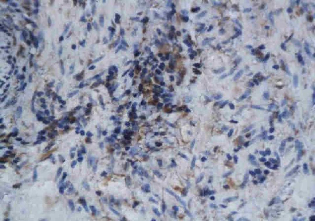 Immunohistochemical analysis of paraffin-embedded human intestine cancer using GM-CSFR Beta antibody.