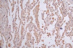 IHC image of CSB-RA156336A0HU diluted at 1:50 and staining in paraffin-embedded human lung cancer performed on a Leica BondTM system. After dewaxing and hydration, antigen retrieval was mediated by high pressure in a citrate buffer (pH 6.0). Section was blocked with 10% normal goat serum 30min at RT. Then primary antibody (1% BSA) was incubated at 4°C overnight. The primary is detected by a Goat anti-rabbit polymer IgG labeled by HRP and visualized using 0.26% DAB.