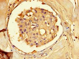 Immunohistochemistry of paraffin-embedded human breast cancer using CSB-PA001474HA01HU at dilution of 1:100