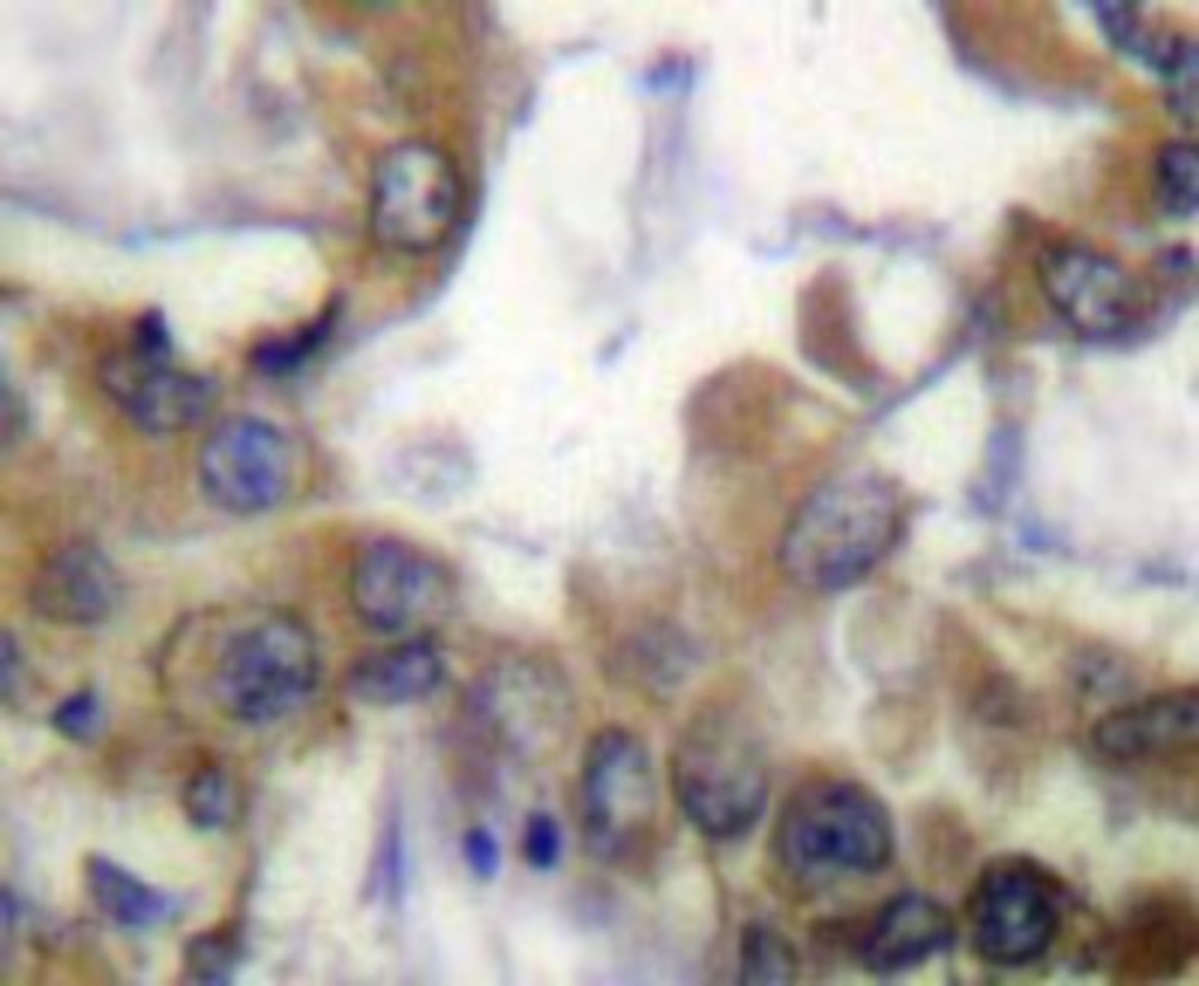 Immunohistochemistry-Paraffin: VEGF Receptor 2/3 Antibody [NBP1-19479] -  Human lung carcinoma tissue.