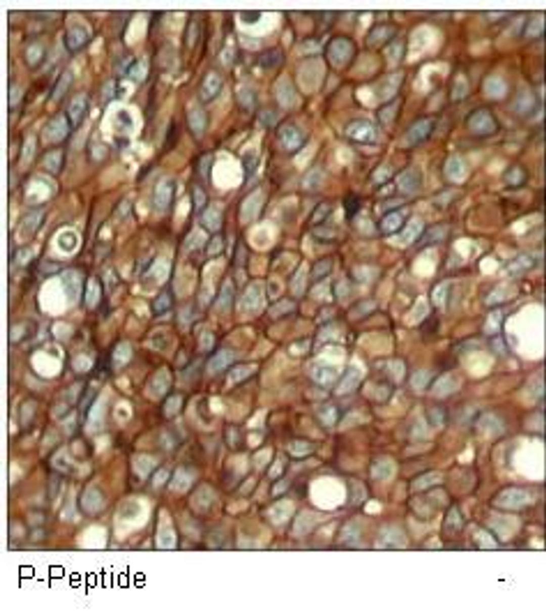 Immunohistochemical analysis of paraffin-embedded human breast carcinoma tissue using HER2 (phospho-Tyr1248) antibody