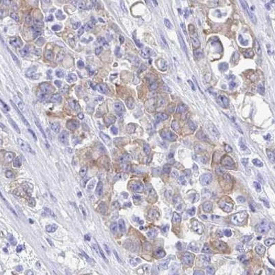 Immunohistochemistry: SEC14L3 Antibody [NBP2-31769] - stomach cancer