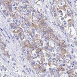 Immunohistochemistry: SEC14L3 Antibody [NBP2-31769] - stomach cancer