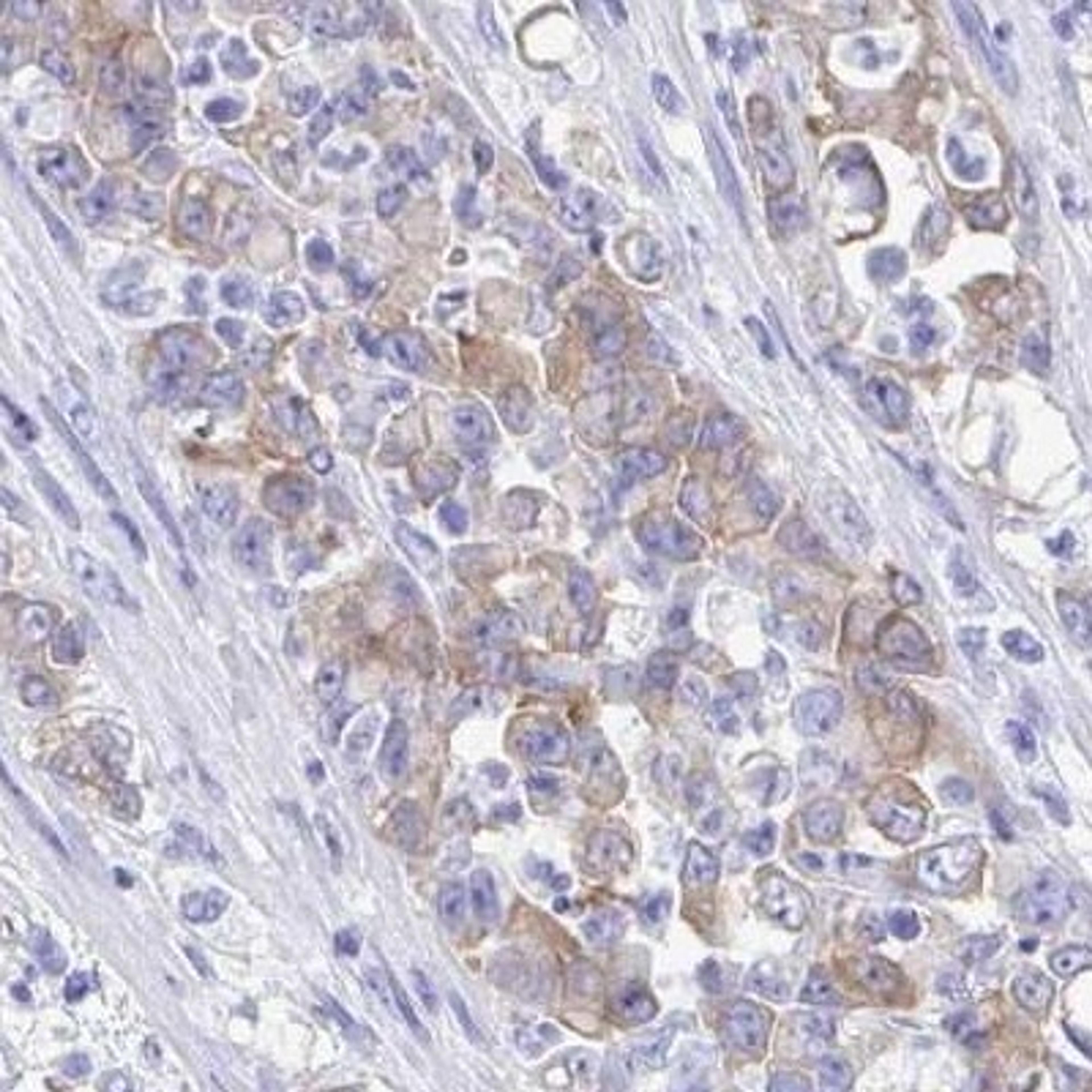 Immunohistochemistry: SEC14L3 Antibody [NBP2-31769] - stomach cancer