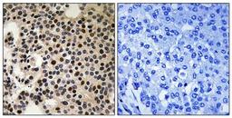 Immunohistochemical analysis of formalin-fixed and paraffin-embedded human breast carcinoma tissue using PAK2 (phospho-Ser197) antibody