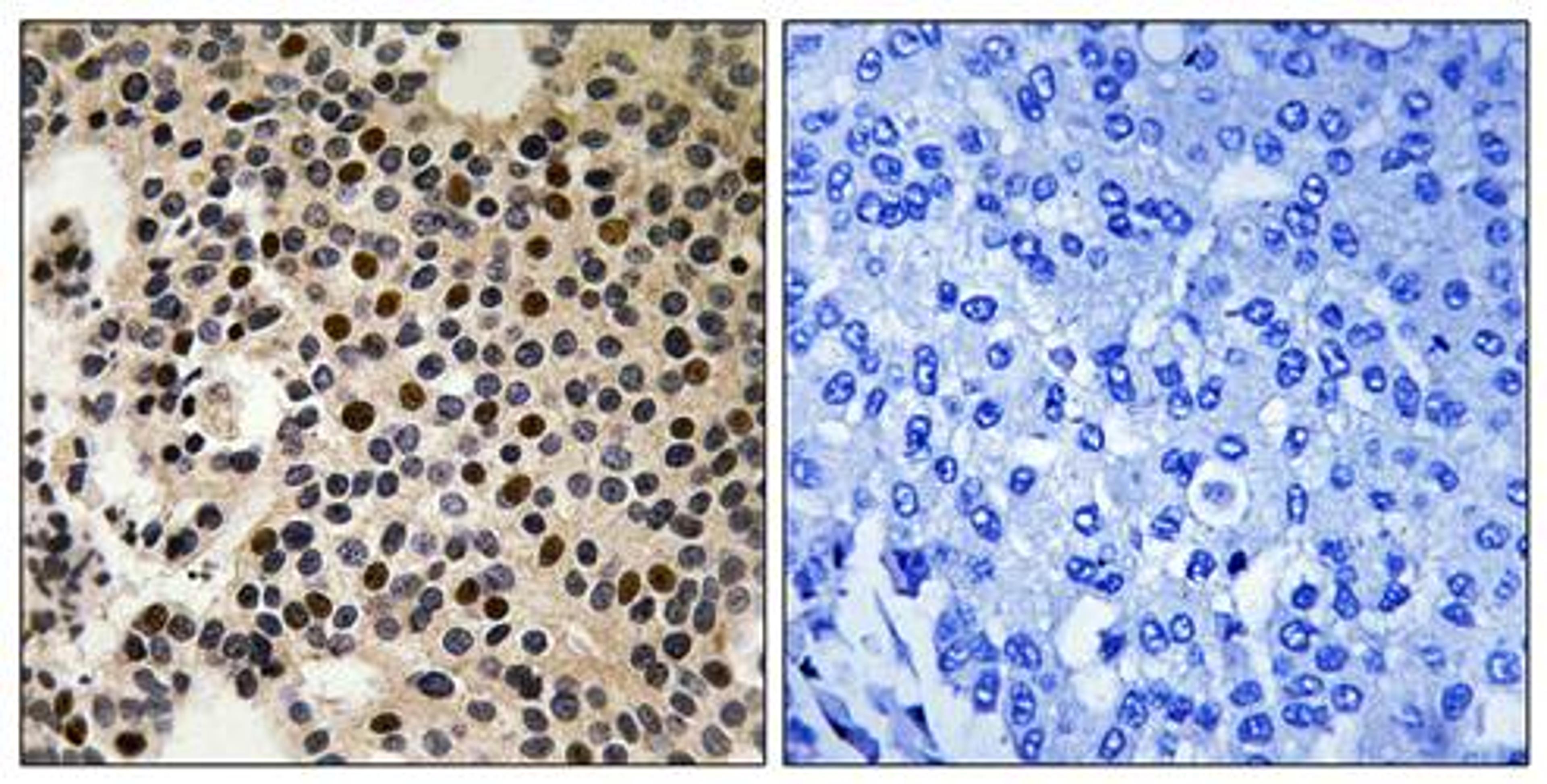 Immunohistochemical analysis of formalin-fixed and paraffin-embedded human breast carcinoma tissue using PAK2 (phospho-Ser197) antibody