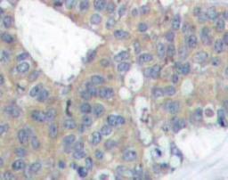 Immunohistochemistry-Paraffin: Paxillin Antibody [NBP1-19833] - Paraffin-embedded human breast carcinoma tissue.