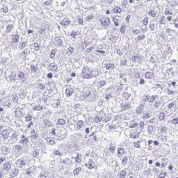 Immunohistochemistry: PINLYP Antibody [NBP2-32588] - liver cancer