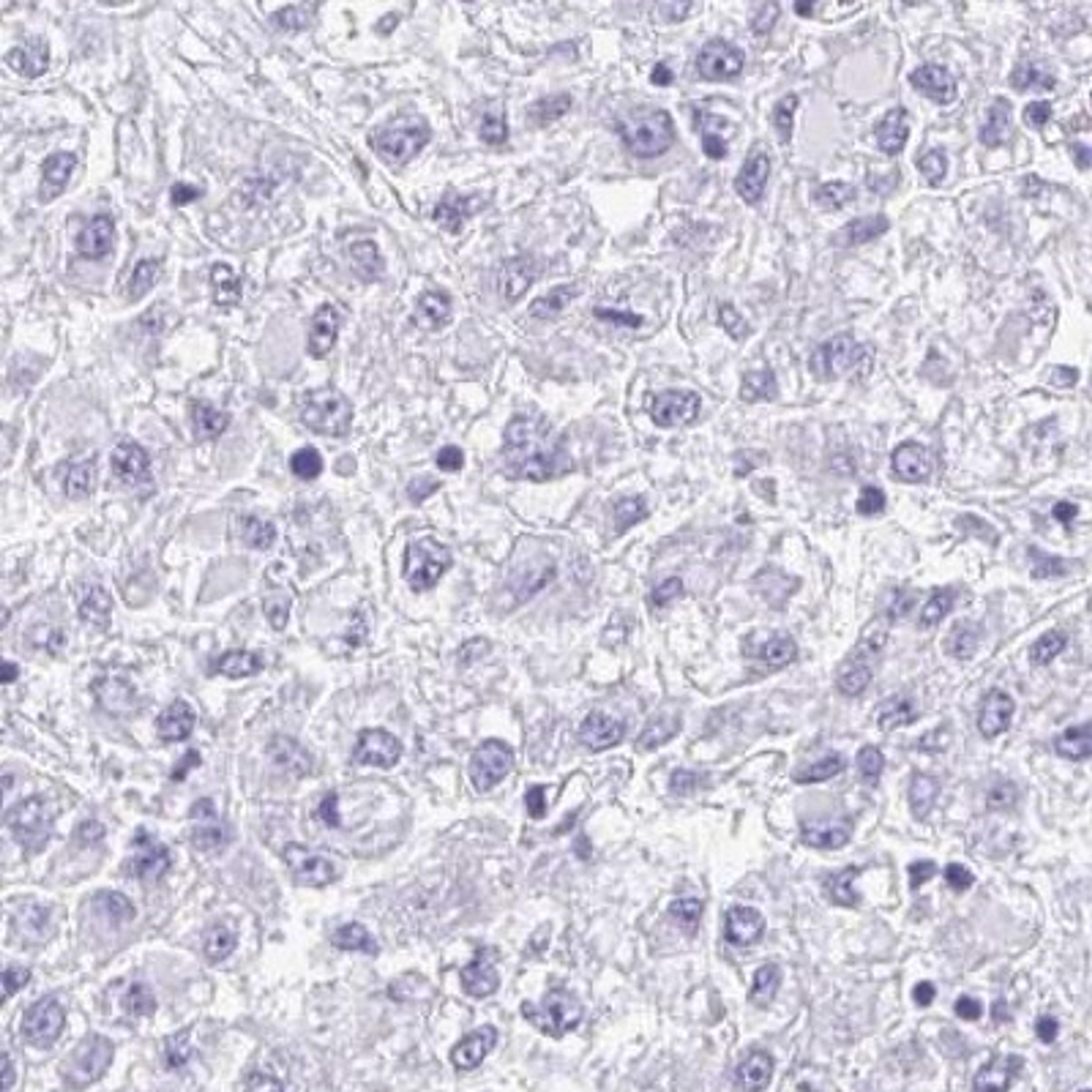 Immunohistochemistry: PINLYP Antibody [NBP2-32588] - liver cancer