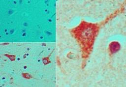 Immunohistochemistry-Paraffin: Nkx2.5 Antibody [NBP2-24675] - Analysis of NKX2-5 in formalin-fixed, paraffin-embedded human brain tissue using an isotype control (top left) and NBP2-24675 (bottom left, right) at 5 ug/ml.