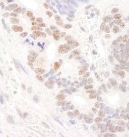 Immunohistochemistry-Paraffin: DDX24 Antibody [NB100-2226] - Human ovarian carcinoma. Antibody used at a dilution of 1:200 (1ug/ml).