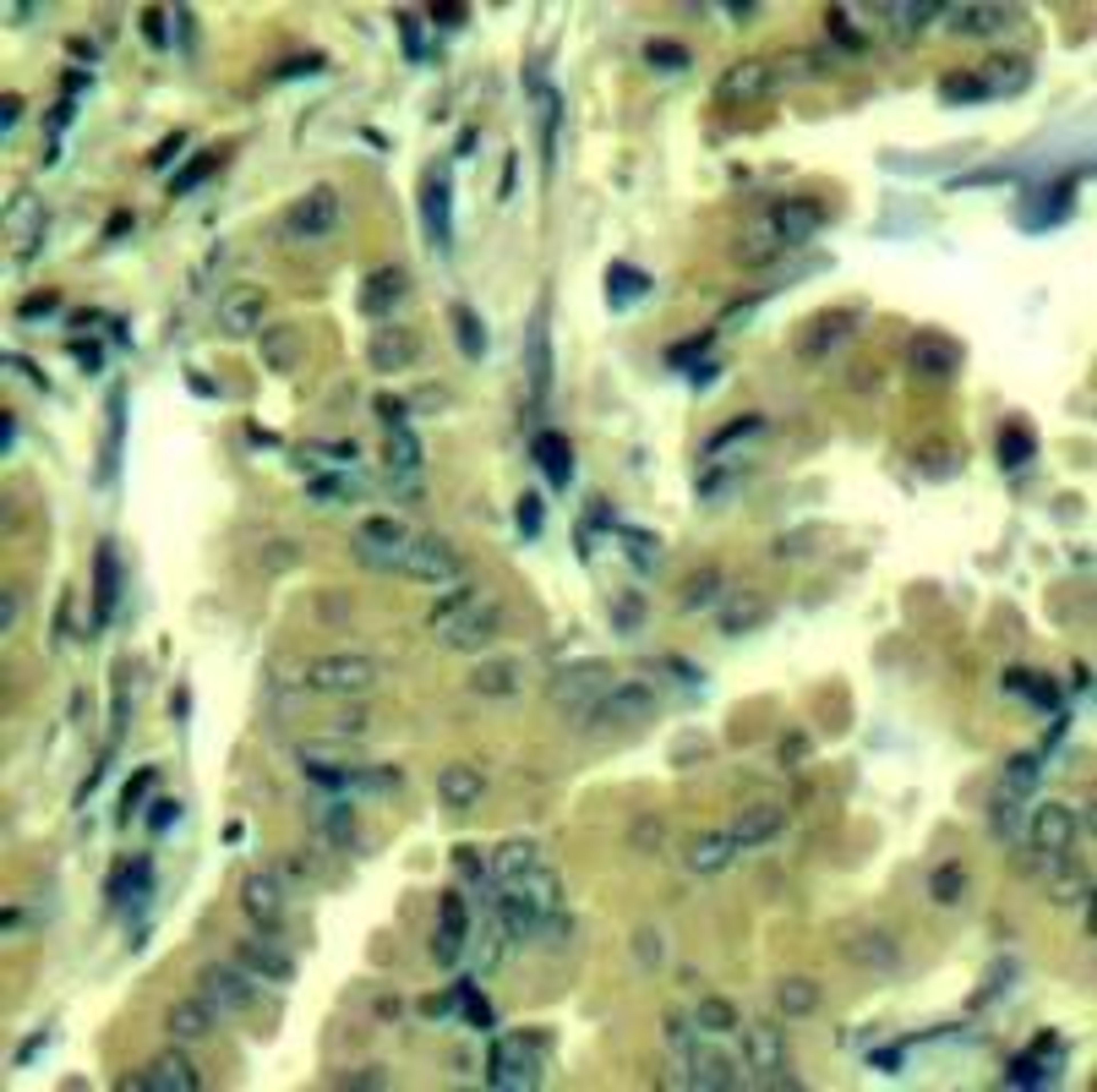 Immunohistochemical analysis of paraffin-embedded human lung carcinoma tissue using PLC-&#947;2 (Ab-1217).