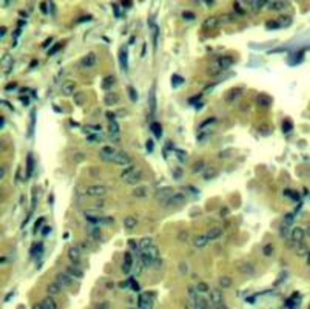 Immunohistochemical analysis of paraffin-embedded human lung carcinoma tissue using PLC-γ2 (Ab-1217).