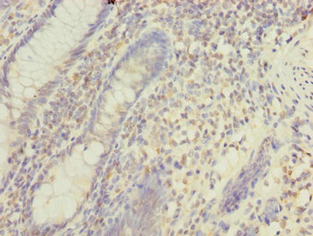 Immunohistochemistry of paraffin-embedded human colon cancer using CSB-PA013748LA01HU at dilution of 1:100