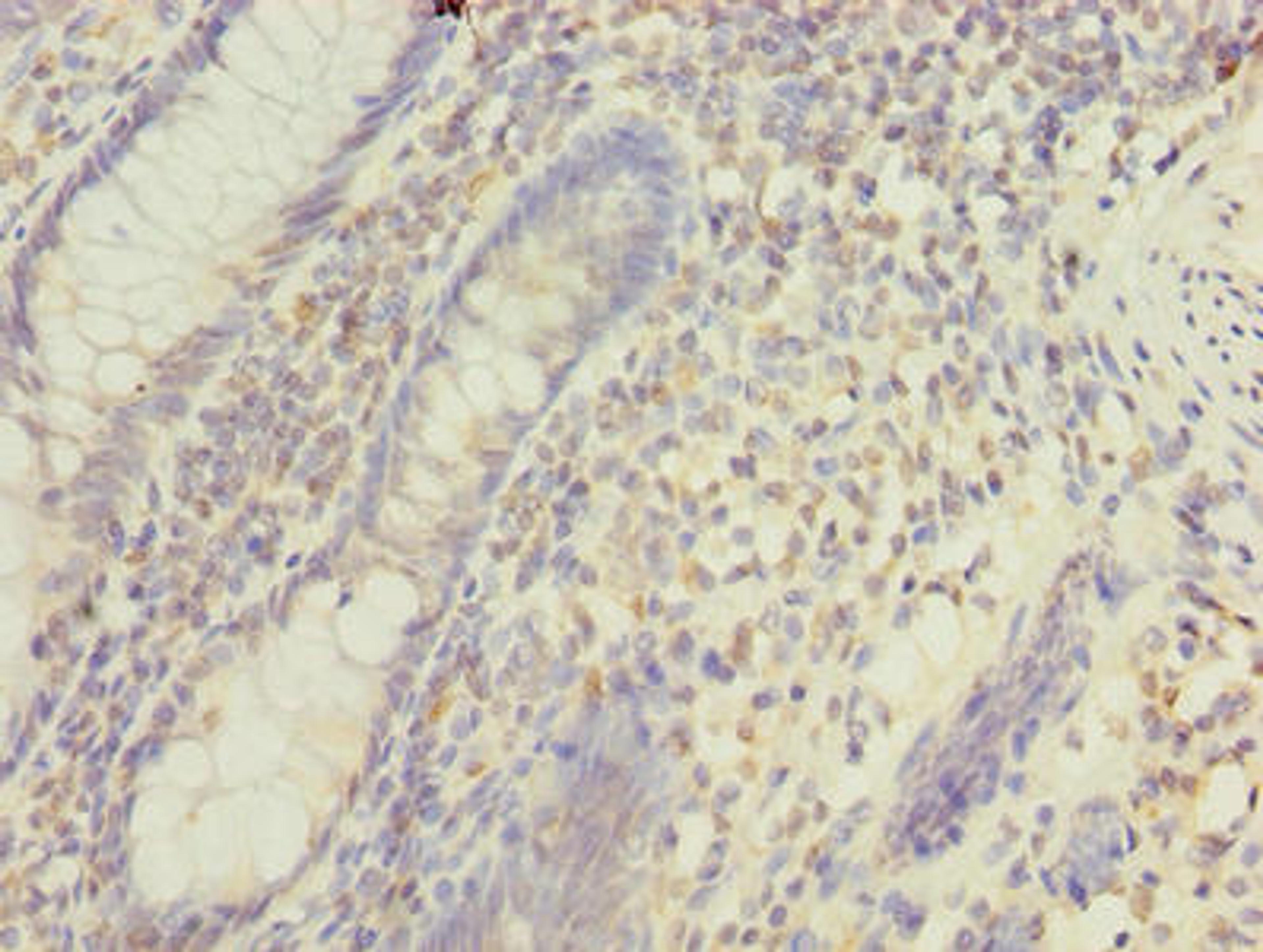 Immunohistochemistry of paraffin-embedded human colon cancer using CSB-PA013748LA01HU at dilution of 1:100