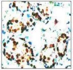 Immunohistochemistry-Paraffin: STAT5A/B Antibody [NBP1-72210] - STAT5A/B Antibody Human breast carcinoma tissue stained with Anti-STAT5 antibody at 1:100 for 10 min @ RT. Staining of formalin-fixed tissue requires boiling tissue sections in 10 mM Citrate Buffer, pH 6.0 for 10 min followed by cooling at RT for 20 min.