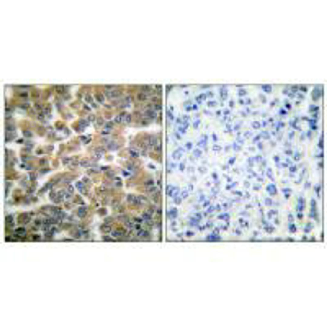 Immunohistochemical analysis of paraffin-embedded human breast carcinoma tissue using GR (Ab-211) antibody.
