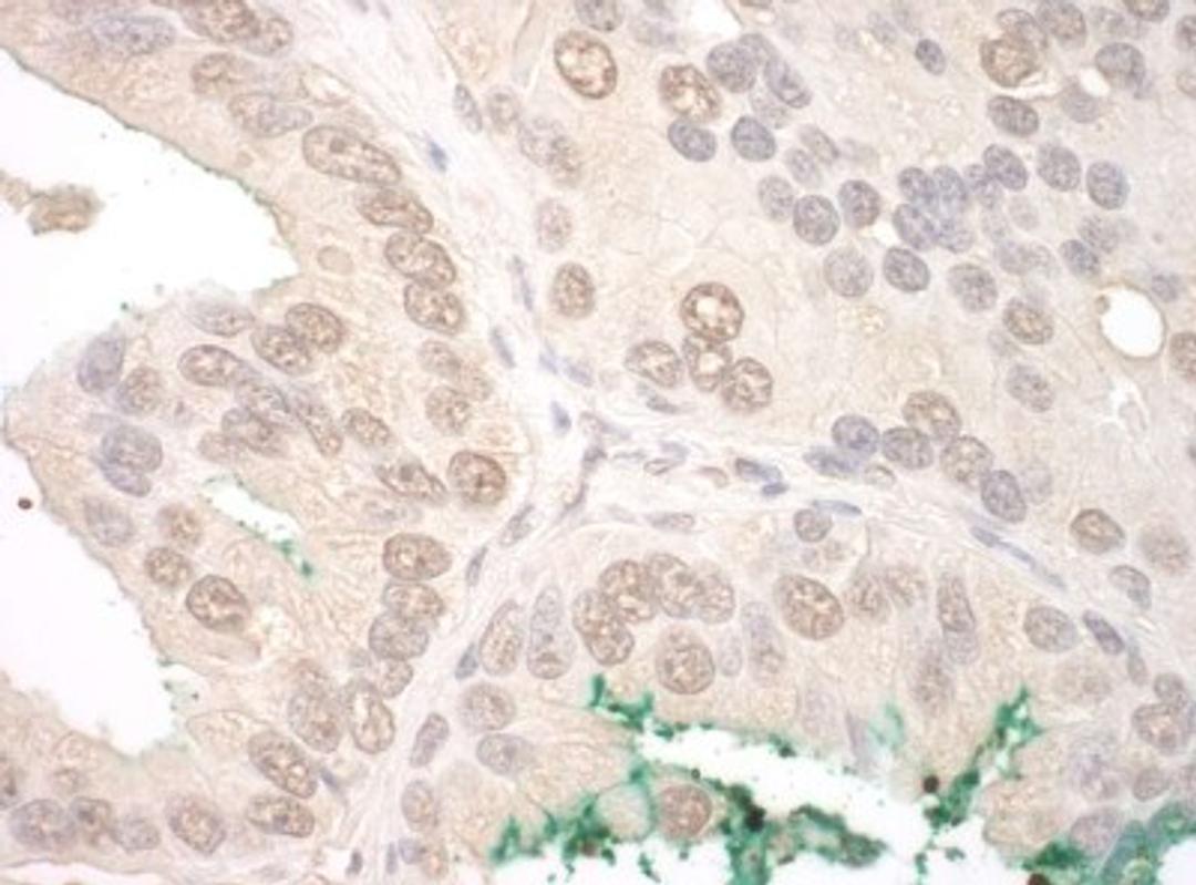 Immunohistochemistry-Paraffin: Orc2 Antibody [NBP1-46175] - Human prostate carcinoma.  Antibody used at a dilution of 1:1,000 (0.2ug/mg).