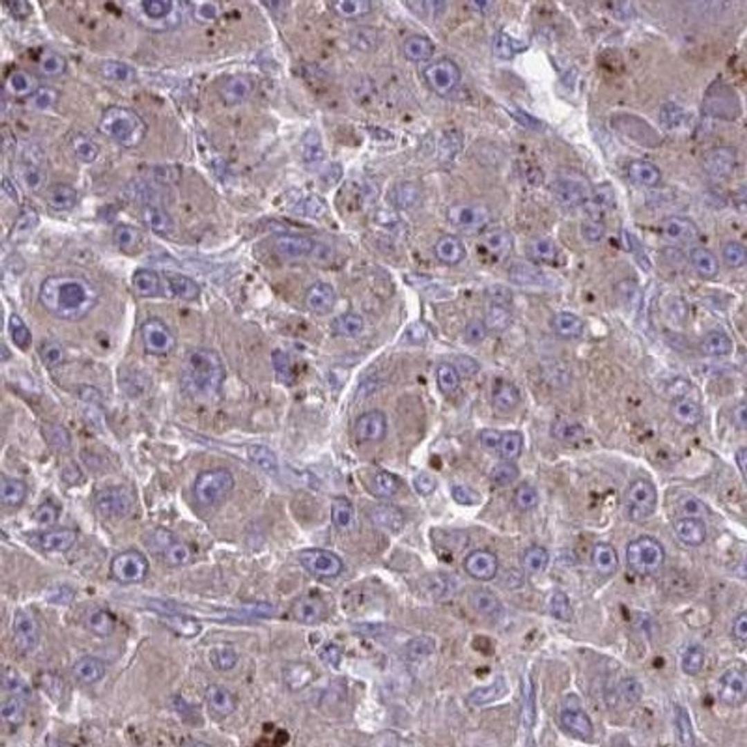 Immunohistochemistry: KIAA1161 Antibody [NBP2-31830] - liver cancer