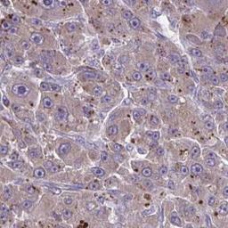 Immunohistochemistry: KIAA1161 Antibody [NBP2-31830] - liver cancer