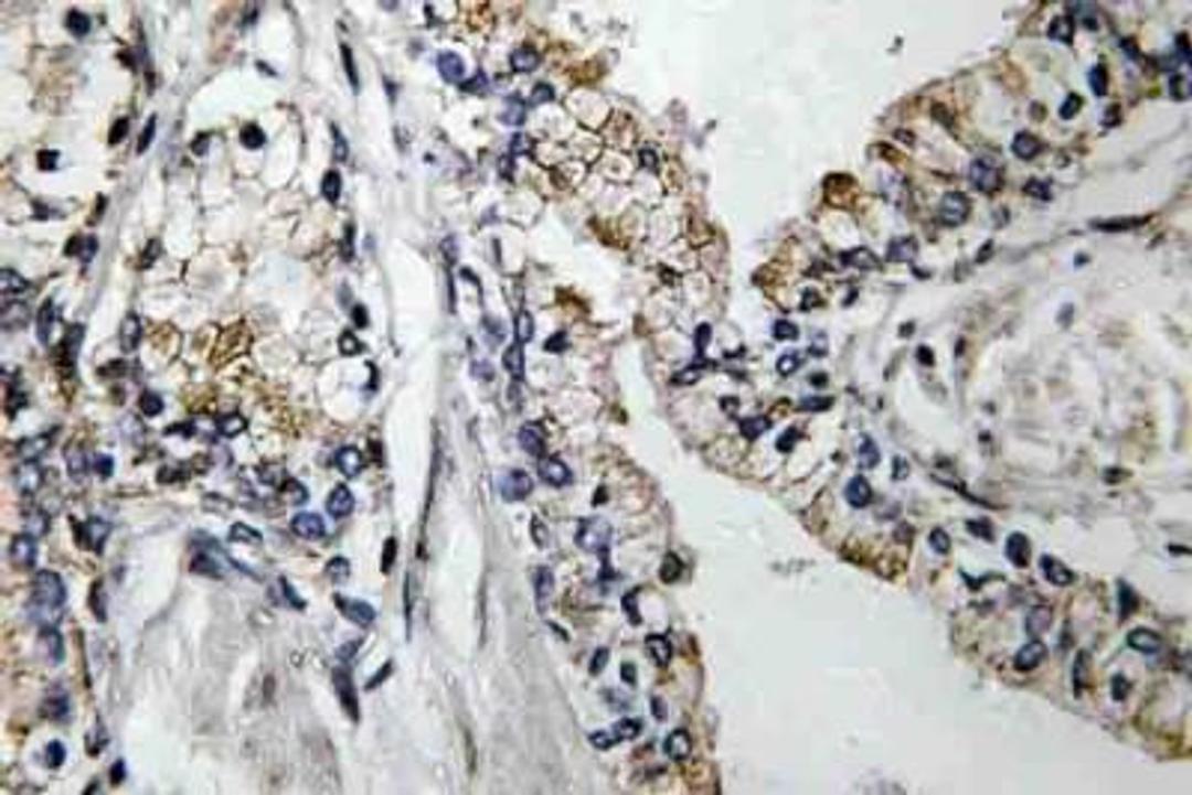 Immunohistochemistry-Paraffin: Claudin-7 Antibody [NBP1-51328] - Human prostate carcinoma tissue.