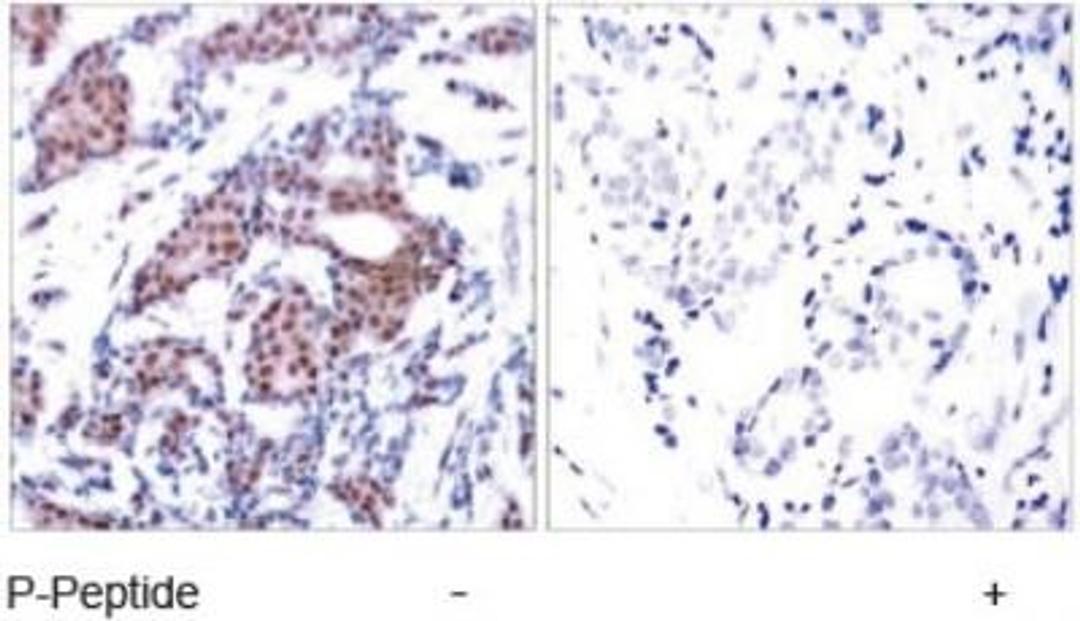 Immunohistochemistry-Paraffin: ELK1 [p Ser383] Antibody [NB100-81904] - Immunohistochemical analysis of paraffin-embedded human breast carcinoma tissue using Elk-1 (phospho-Ser383) antibody NB100-81904. The image on the right shows staining using the same antibody preincubated with blocking peptide(right).