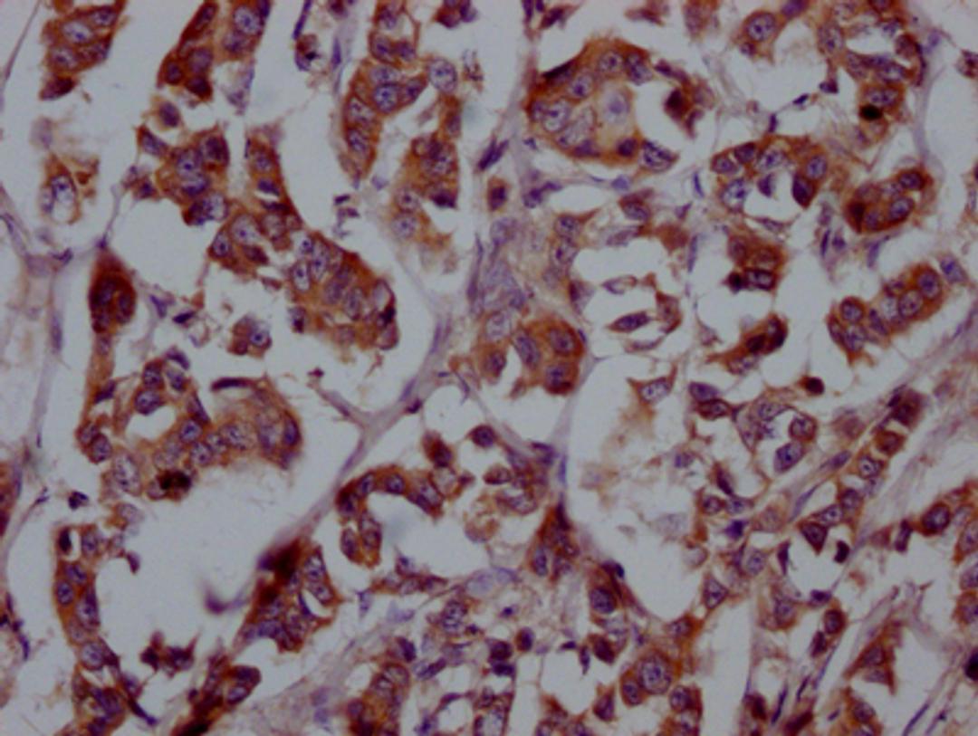 IHC image of CSB-RA927449A0HU diluted at 1:100 and staining in paraffin-embedded human breast cancer performed on a Leica BondTM system. After dewaxing and hydration, antigen retrieval was mediated by high pressure in a citrate buffer (pH 6.0). Section was blocked with 10% normal goat serum 30min at RT. Then primary antibody (1% BSA) was incubated at 4℃ overnight. The primary is detected by a Goat anti-rabbit IgG polymer labeled by HRP and visualized using 0.05% DAB.