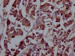 IHC image of CSB-RA927449A0HU diluted at 1:100 and staining in paraffin-embedded human breast cancer performed on a Leica BondTM system. After dewaxing and hydration, antigen retrieval was mediated by high pressure in a citrate buffer (pH 6.0). Section was blocked with 10% normal goat serum 30min at RT. Then primary antibody (1% BSA) was incubated at 4℃ overnight. The primary is detected by a Goat anti-rabbit IgG polymer labeled by HRP and visualized using 0.05% DAB.