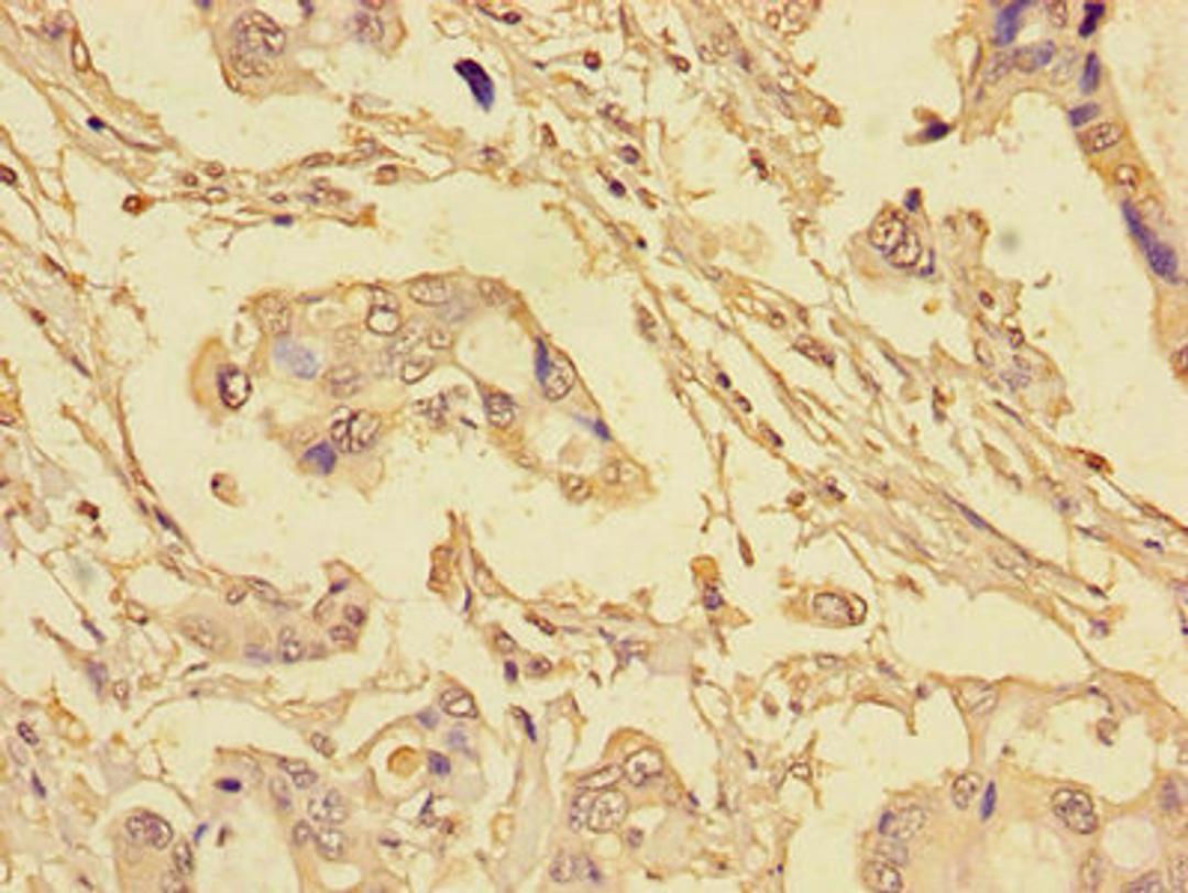 Immunohistochemistry of paraffin-embedded human pancreatic cancer using CSB-PA623815LA01HU at dilution of 1:100