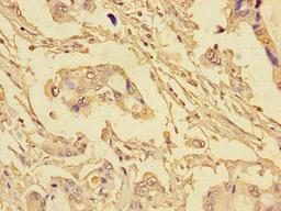 Immunohistochemistry of paraffin-embedded human pancreatic cancer using CSB-PA623815LA01HU at dilution of 1:100