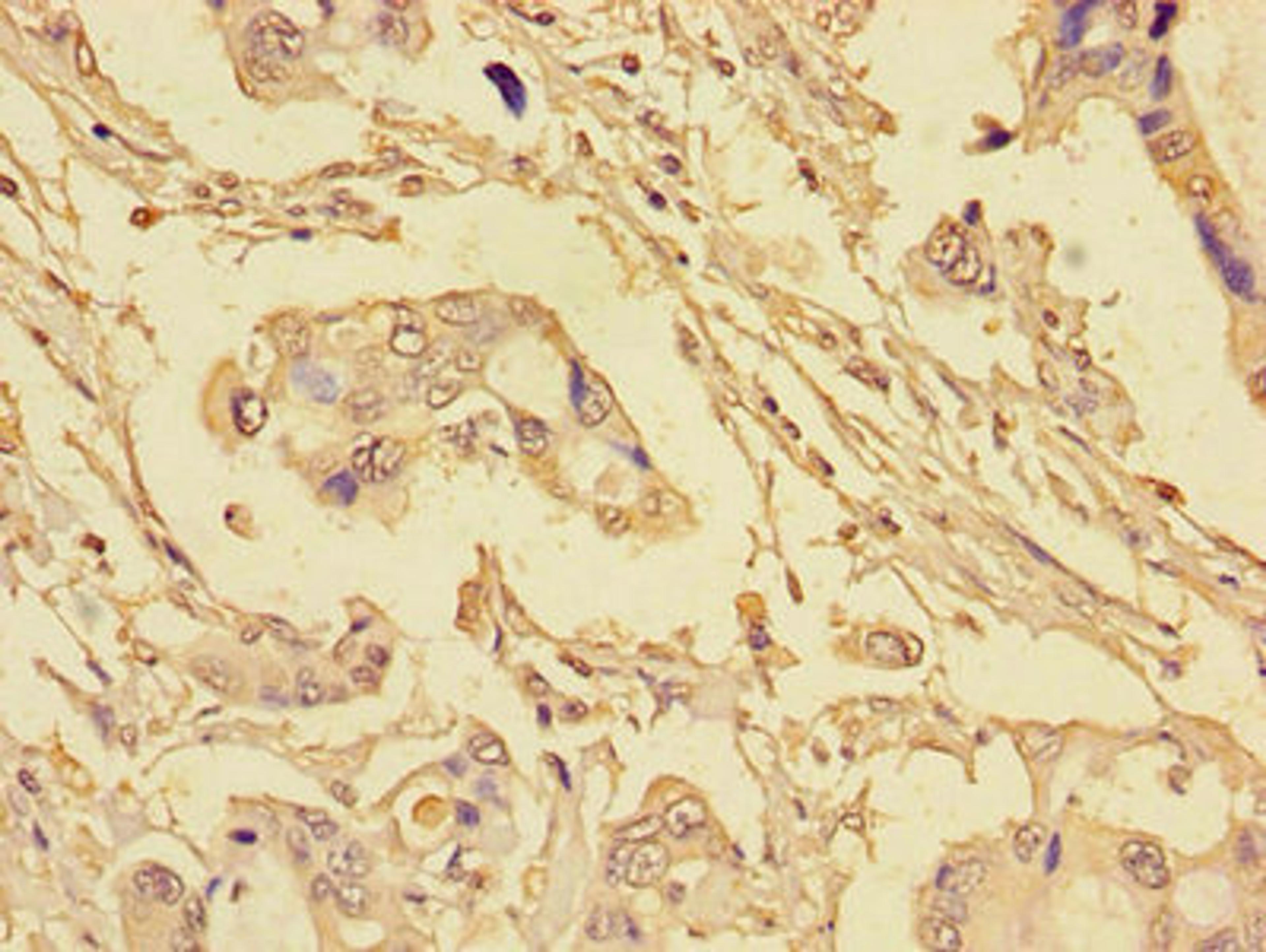 Immunohistochemistry of paraffin-embedded human pancreatic cancer using CSB-PA623815LA01HU at dilution of 1:100