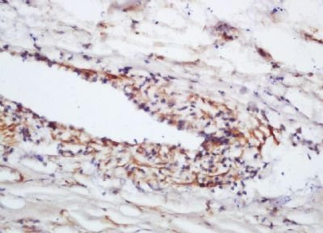 Immunohistochemical analysis of formalin-fixed paraffin embedded human lung carcinoma tissue using eNOS (phospho-Ser1177) antibody (dilution at 1:200)