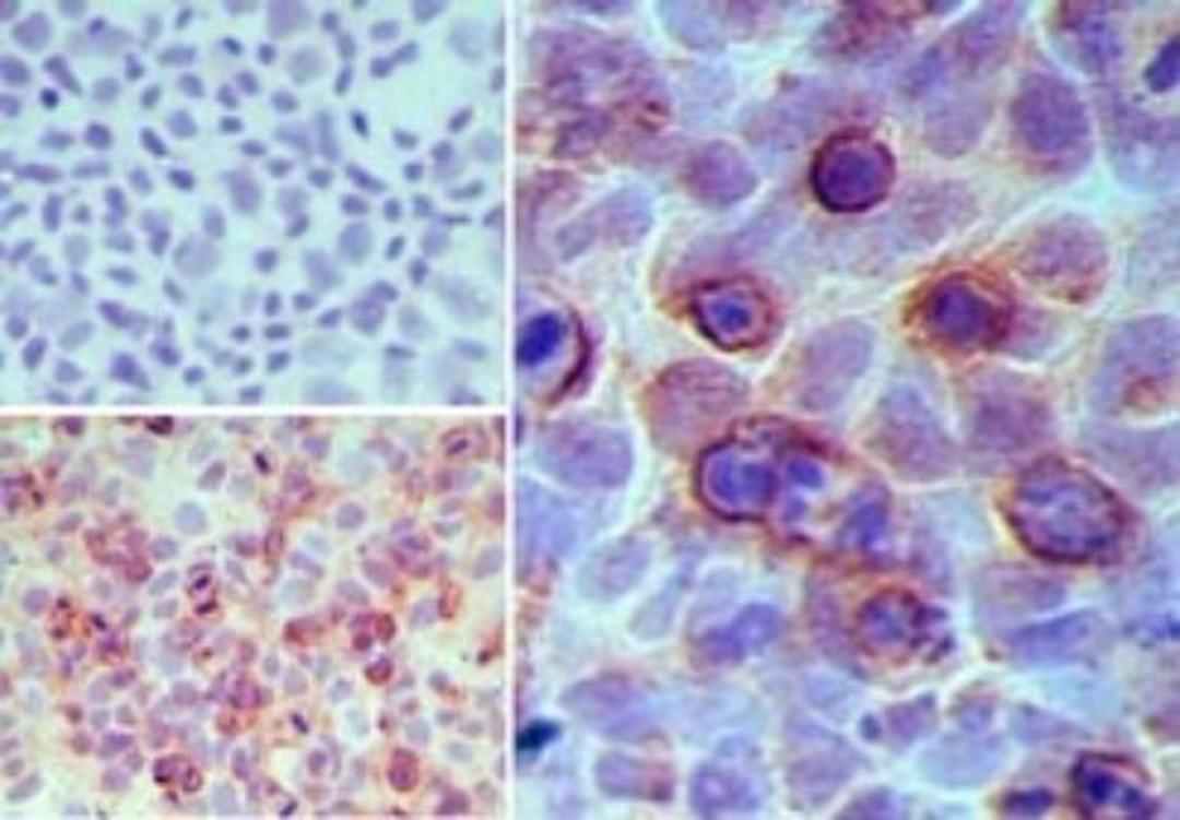 Immunohistochemistry-Paraffin: GPR35 Antibody [NBP2-24640] - Analysis of GPR35 in paraffin-embedded formalin-fixed MCF7cells using an isotype control (top left) and NBP2-24640 (bottom left, right) at 5 ug/ml.