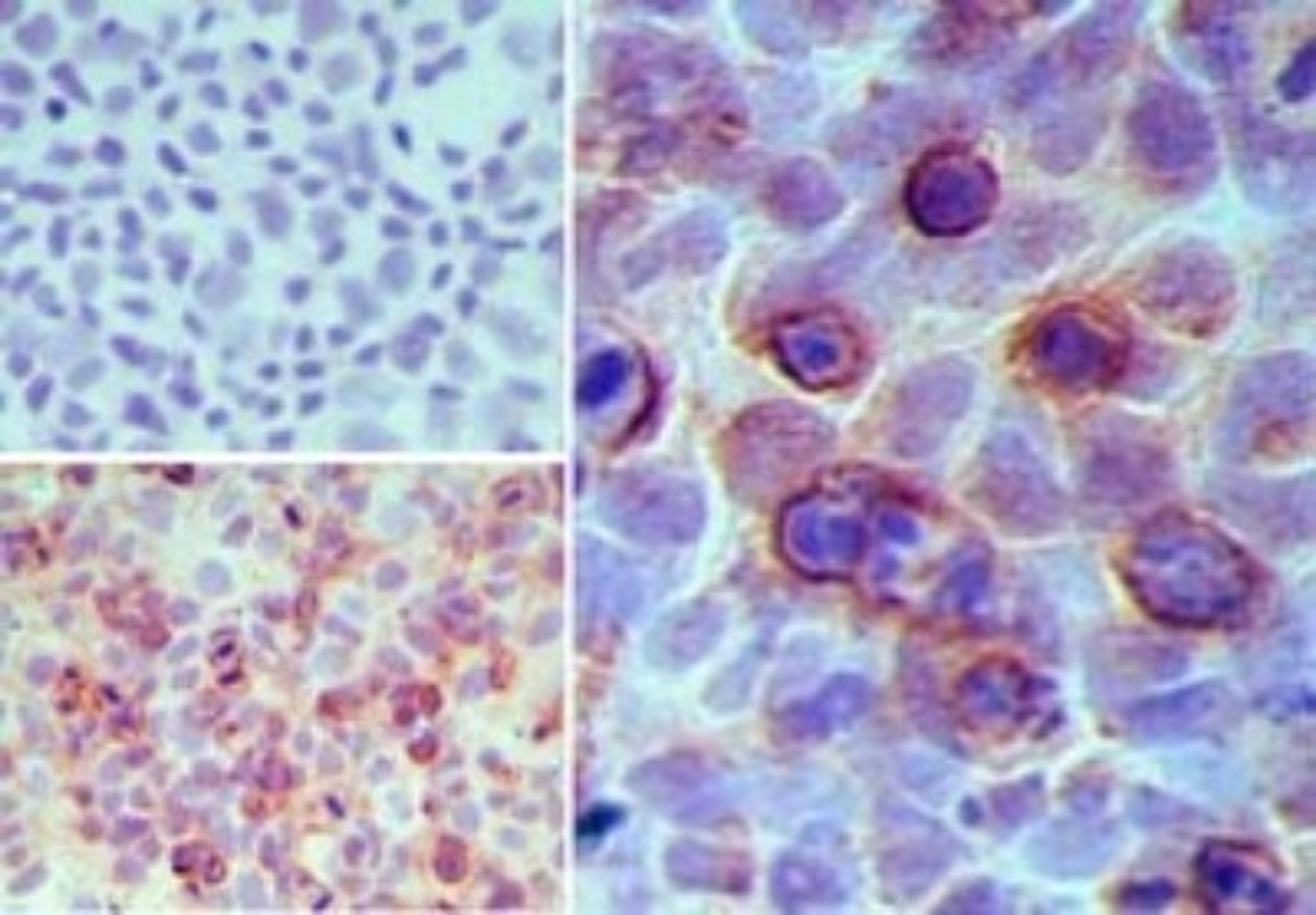 Immunohistochemistry-Paraffin: GPR35 Antibody [NBP2-24640] - Analysis of GPR35 in paraffin-embedded formalin-fixed MCF7cells using an isotype control (top left) and NBP2-24640 (bottom left, right) at 5 ug/ml.