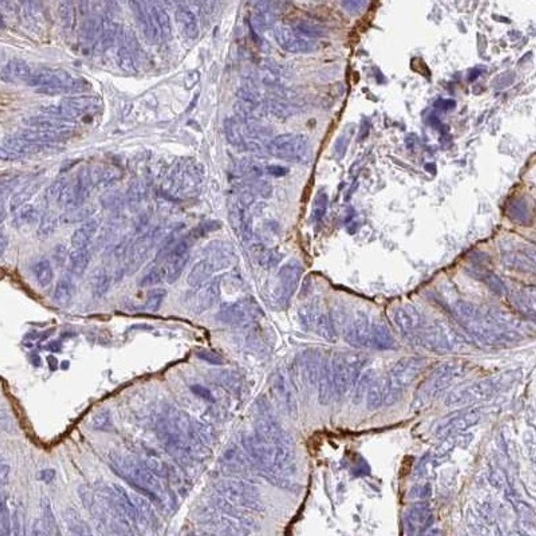 Immunohistochemistry: ANKRD29 Antibody [NBP2-33564] - colorectal cancer