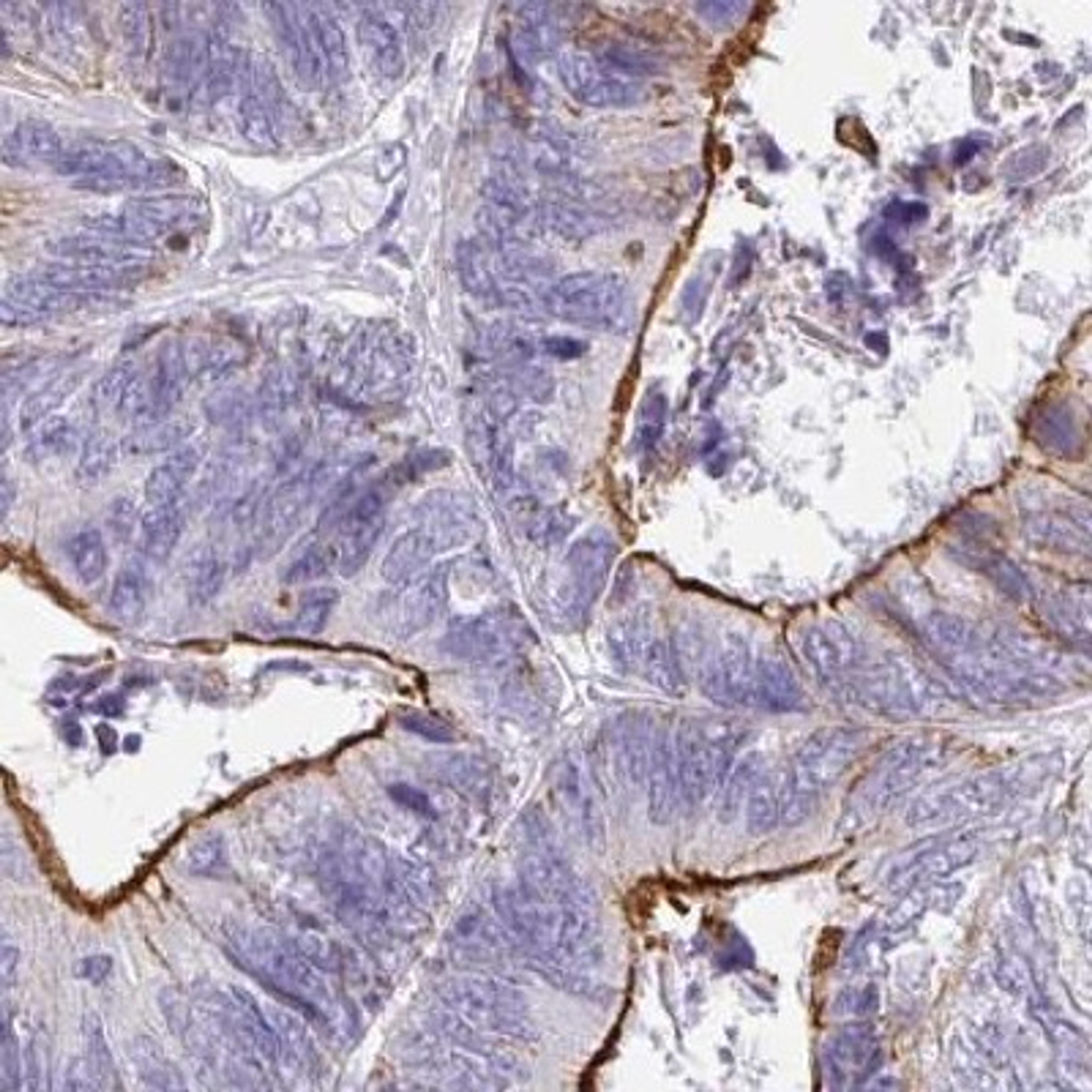 Immunohistochemistry: ANKRD29 Antibody [NBP2-33564] - colorectal cancer