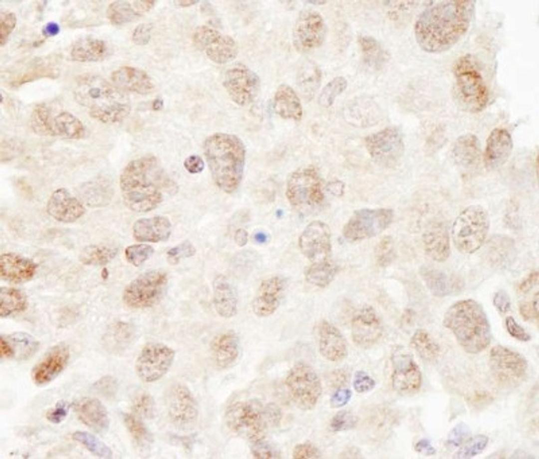 Immunohistochemistry-Paraffin: Cullin 3 Antibody [NB100-58788] - Human breast carcinoma. Antibody used at a dilution of1:200 (1ug/ml).