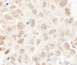 Immunohistochemistry-Paraffin: Cullin 3 Antibody [NB100-58788] - Human breast carcinoma. Antibody used at a dilution of1:200 (1ug/ml).