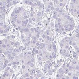 Immunohistochemistry: HGFAC Antibody [NBP2-31710] - breast cancer