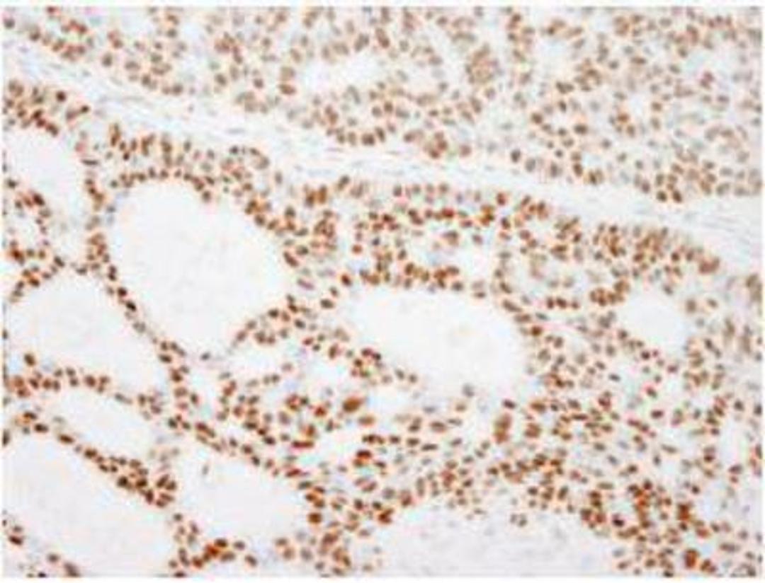 Immunohistochemistry-Paraffin: RCC2 Antibody [NB110-40619] - FFPE section of human basal cell carcinoma.  Antibody used at a dilution of 1:500.