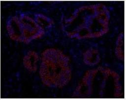 Immunocytochemistry/Immunofluorescence: ABCB9 Antibody [NBP1-18886] - FFPE section of human prostate carcinoma. Antibody:  Affinity purified rabbit anti-ABCB9 used  at a dilution of 1:100. Detection: Red-fluorescent goat anti-rabbit IgG highly cross-adsorbed Antibody Hilyte PlusTM 555 used at a dilution of 1:100.